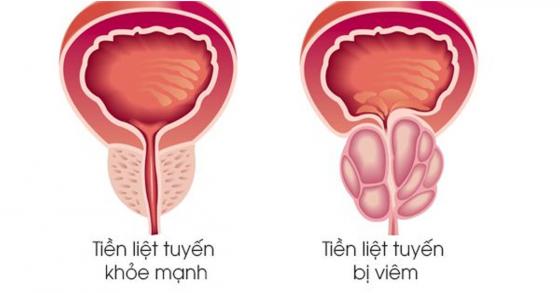 Bệnh viêm tuyến tiền liệt ở nam giới có nguy hiểm không?