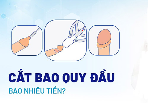 Cắt bao quy đầu bao nhiêu tiền? Lưu ý khi cắt bao quy đầu
