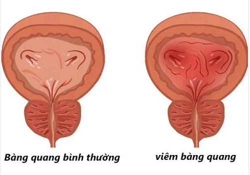 Viêm bàng quang ở nữ – Nguyên nhân, triệu chứng, tác hại và cách chữa trị