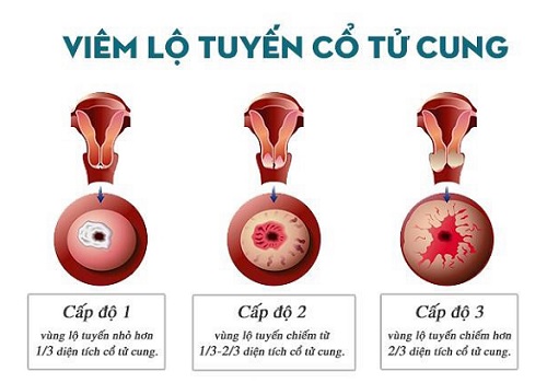 Viêm lộ tuyến cổ tử cung – bệnh lý phụ khoa nguy hiểm có thể dẫn đến ung thư