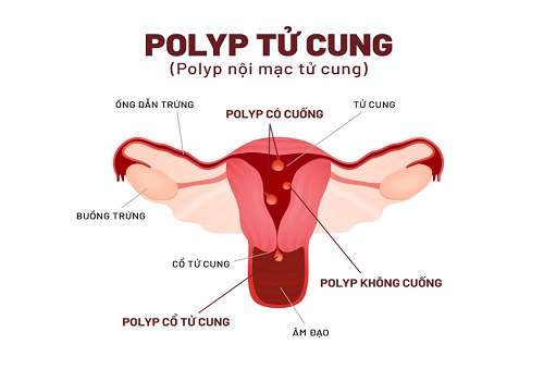 Polyp tử cung có nguy hiểm không? Điều trị bằng cách nào?