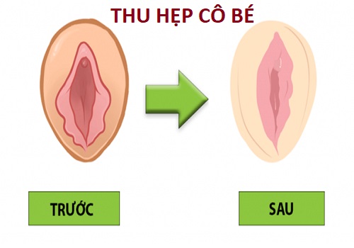 Vì sao nên thu hẹp cô bé? Thực hiện thu hẹp ở đâu an toàn, thẩm mỹ?