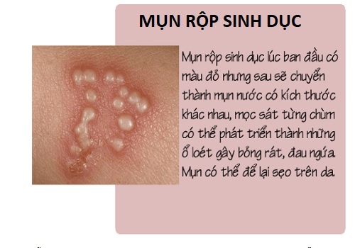 Nổi mụn ở vùng kín nữ là bệnh gì? Có nguy hiểm không? Điều trị thế nào?